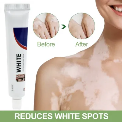 Oq-vitiligo davolash uchun krem, 20 g